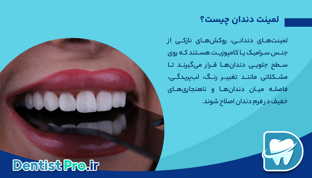 لمینت دندان آلمانی: ترکیبی از تکنولوژی، زیبایی و دوام