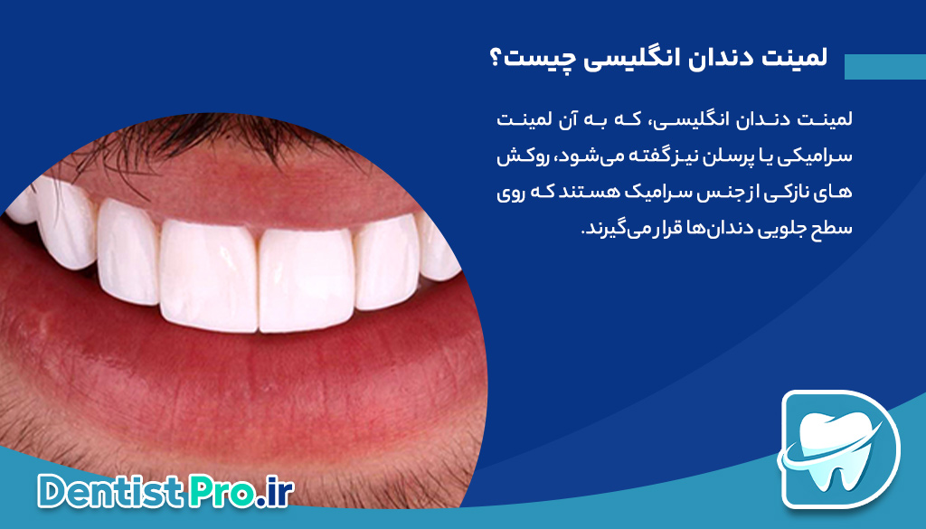 لمینت دندان انگلیسی: راهی به سوی لبخندی زیبا و طبیعی