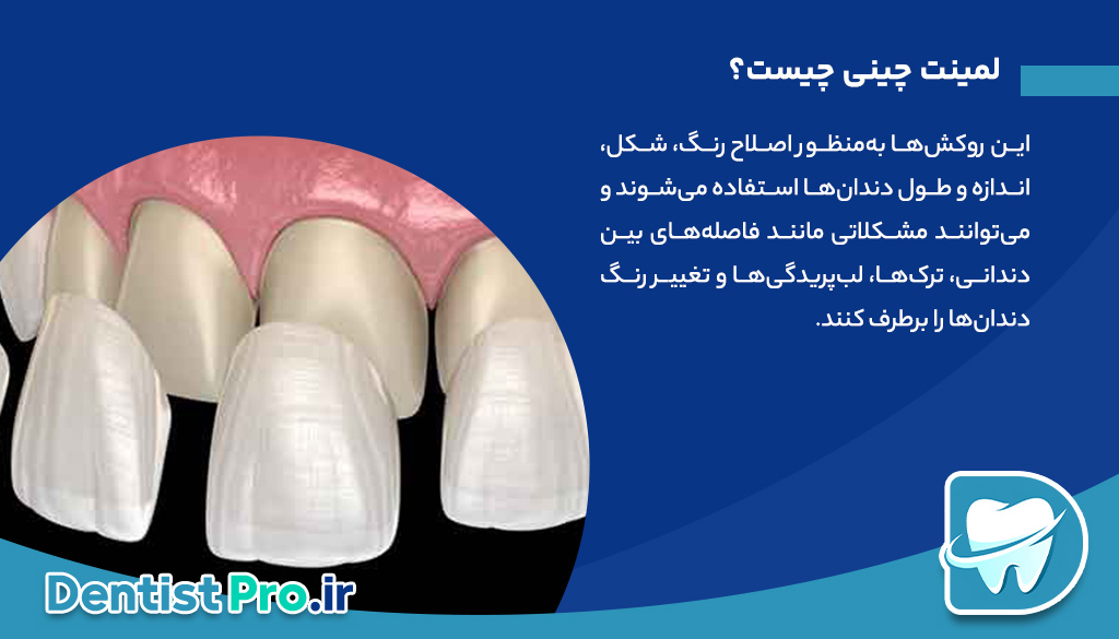 لمینت دندان چینی: راهی به سوی لبخندی زیبا و طبیعی 26 لمینت دندان چینی: راهی به سوی لبخندی زیبا و طبیعی