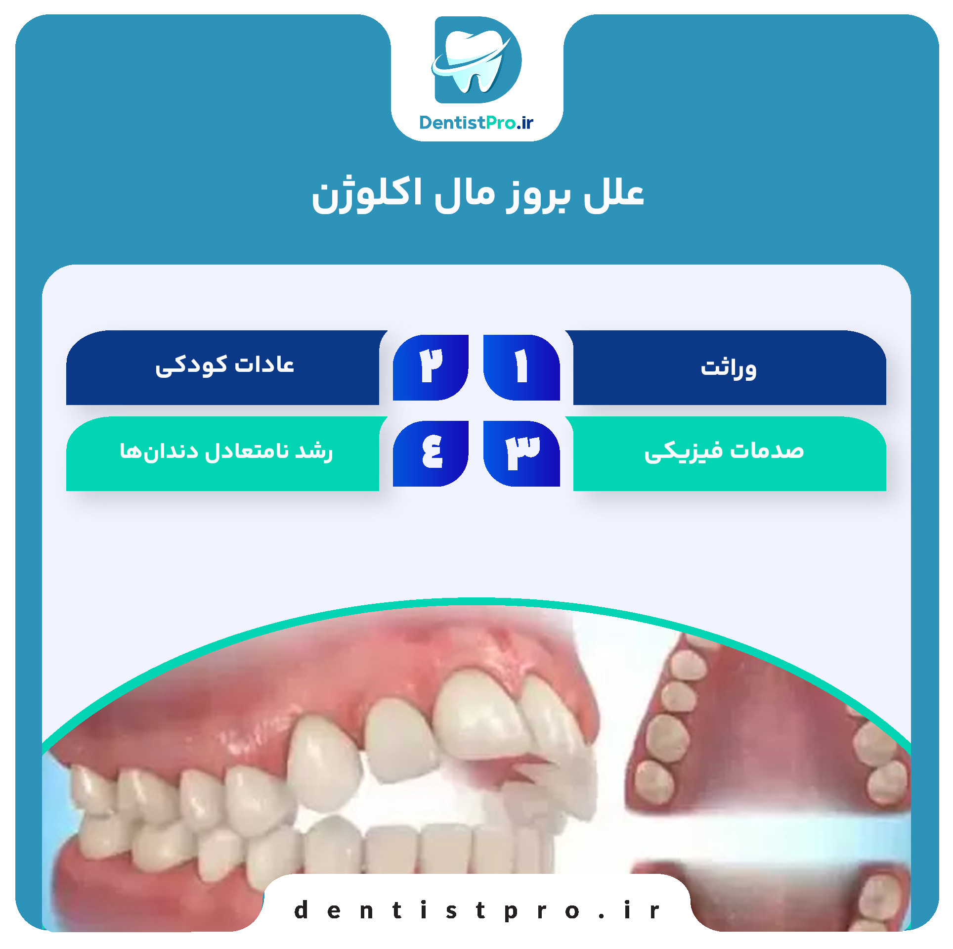 مال اکلوژن: بررسی جامع اختلالات قرارگیری دندانها و راههای درمانی 27 مال اکلوژن: بررسی جامع اختلالات قرارگیری دندانها و راههای درمانی