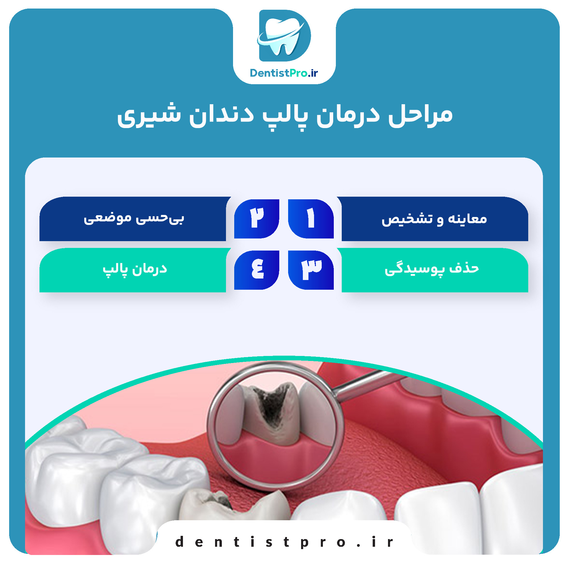 درمان پالپ دندان شیری: راهنمای جامع حفظ سلامت دندان‌های کودکان