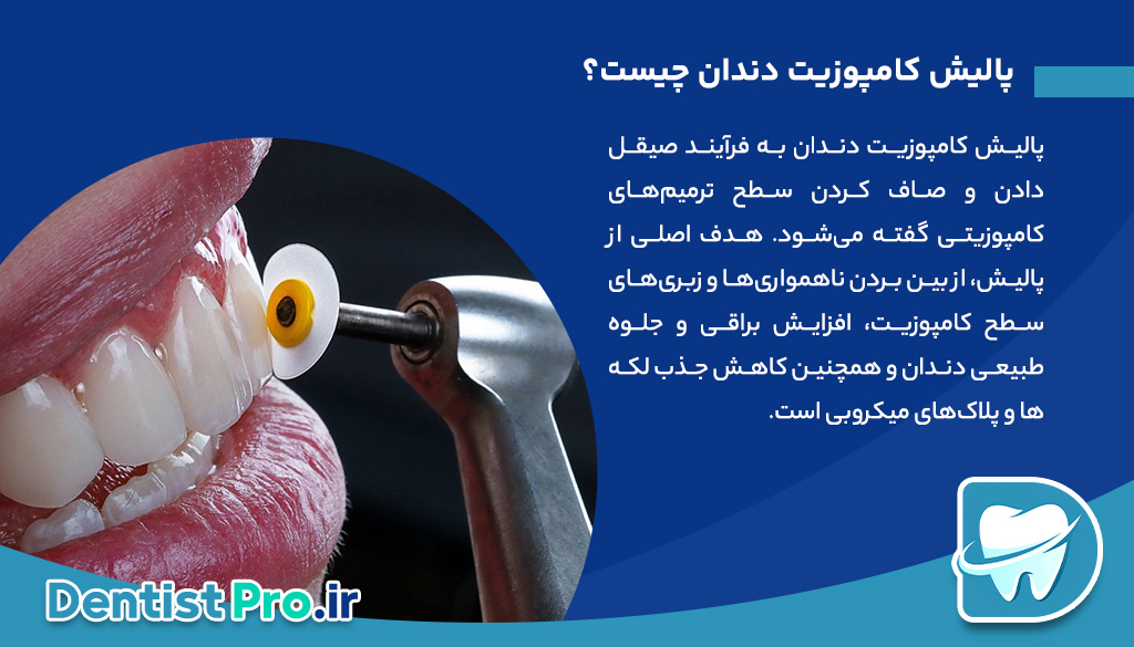 پالیش کامپوزیت دندان؛ راهی برای زیبایی و دوام بیشتر ترمیم‌های کامپوزیتی