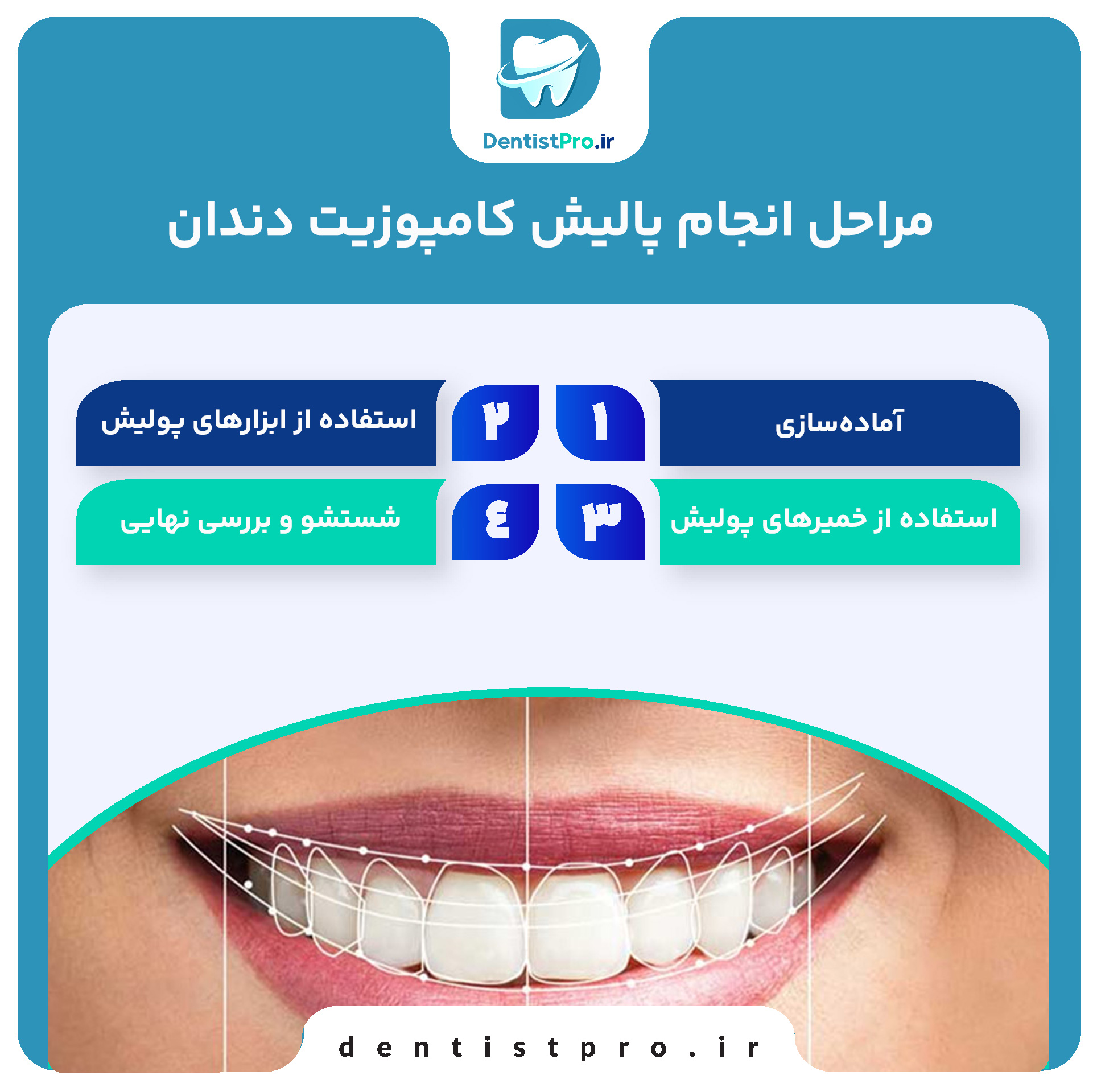 پالیش کامپوزیت دندان؛ راهی برای زیبایی و دوام بیشتر ترمیم‌های کامپوزیتی