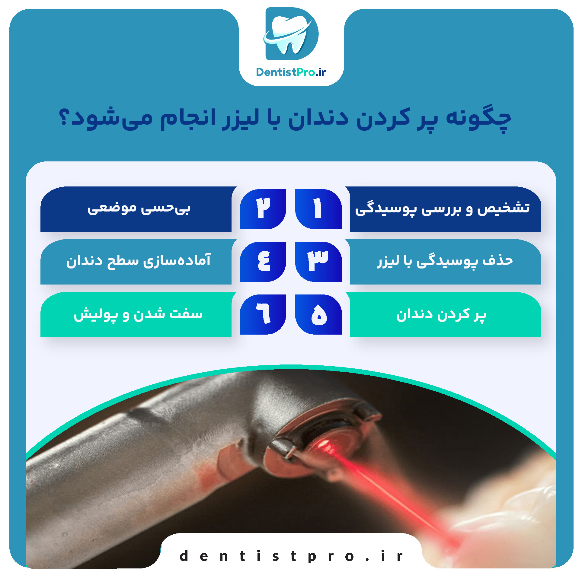 پر کردن دندان با لیزر: تحولی نوین در درمان پوسیدگی دندان