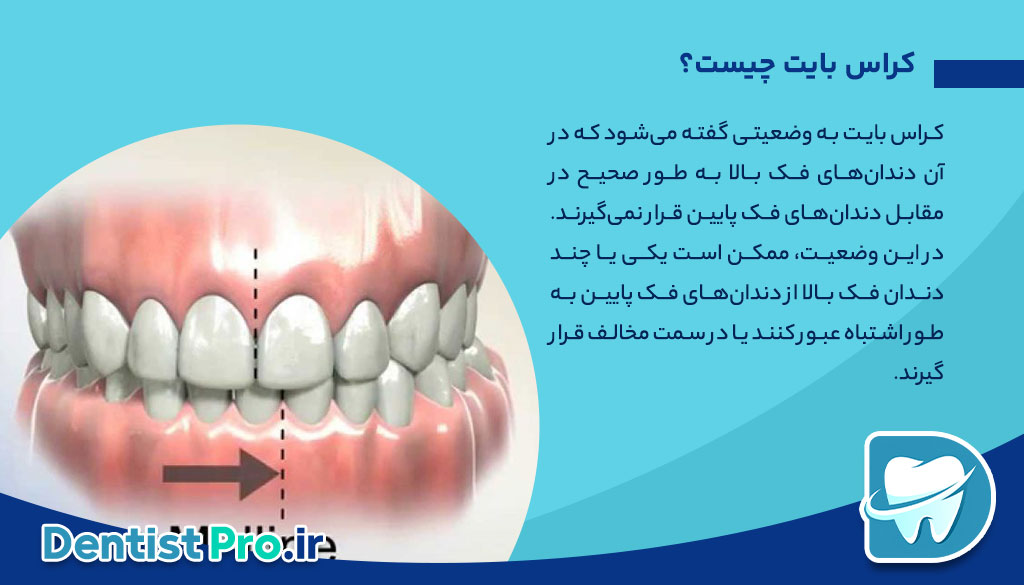 درمان کراس بایت با ارتودنسی