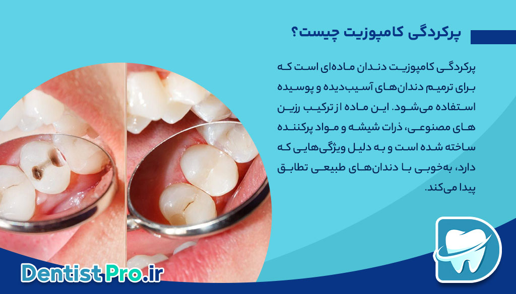مزایای پرکردگی کامپوزیت دندان: چرا این انتخاب بهترین است؟