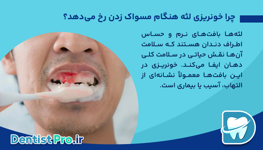 10 دلیل به عنوان دلایل خونریزی لثه هنگام مسواک زدن