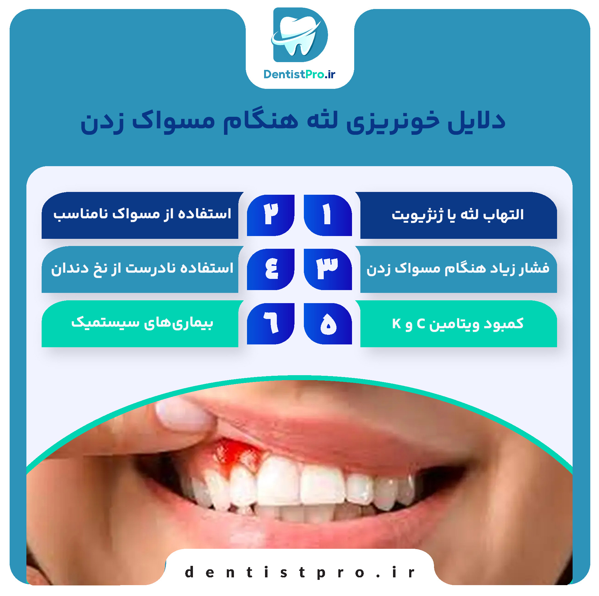 10 دلیل به عنوان دلایل خونریزی لثه هنگام مسواک زدن