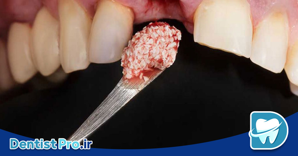 پودر استخوان در دندانپزشکی؛ کاربردها، انواع و مزایا