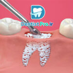 پودر استخوان در دندانپزشکی؛ کاربردها، انواع و مزایا
