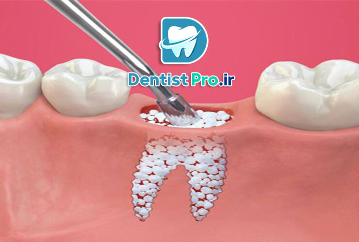 پودر استخوان در دندانپزشکی؛ کاربردها، انواع و مزایا 47 پودر استخوان در دندانپزشکی؛ کاربردها، انواع و مزایا