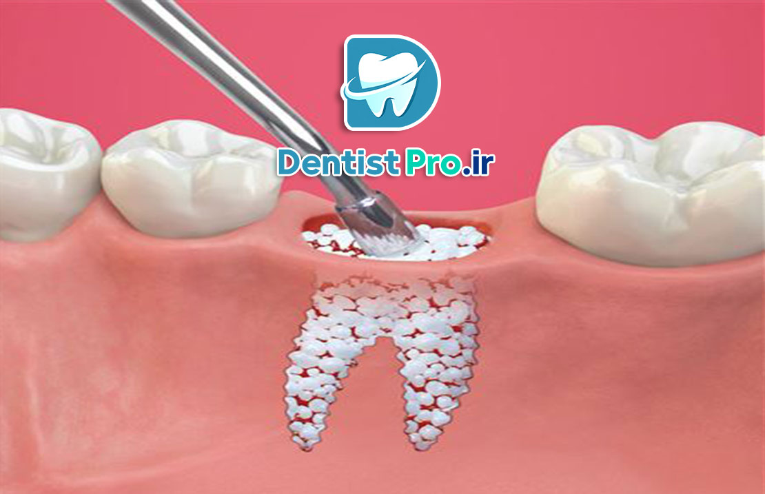 پودر استخوان در دندانپزشکی؛ کاربردها، انواع و مزایا