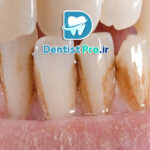 لکه قهوه ای روی دندان+ 0 تا 100 دلایل، پیشگیری و درمان