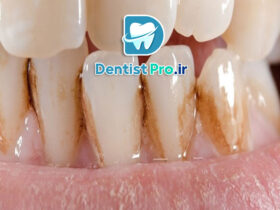 لکه قهوه ای روی دندان+ 0 تا 100 دلایل، پیشگیری و درمان