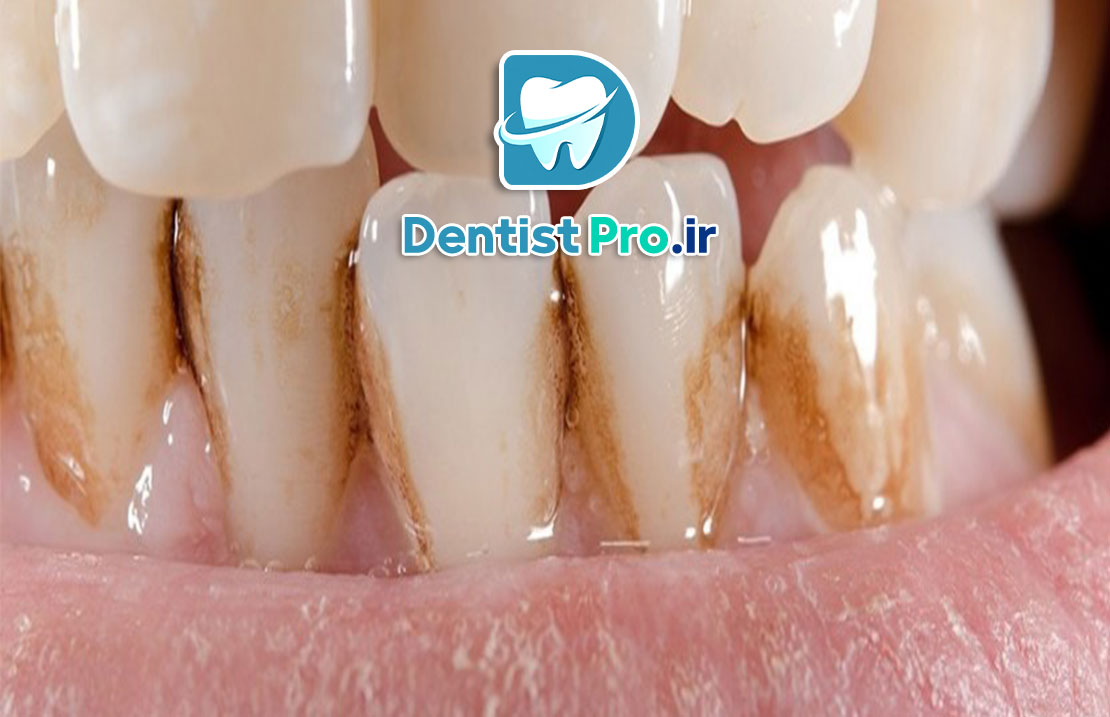 لکه قهوه ای روی دندان+ 0 تا 100 دلایل، پیشگیری و درمان