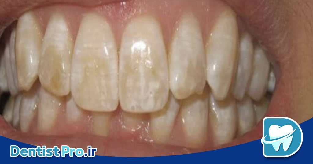 لکه قهوه ای روی دندان: دلایل، پیشگیری و درمان