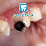 علت سیاه شدن دندان از داخل