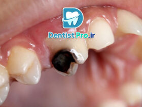 علت سیاه شدن دندان از داخل