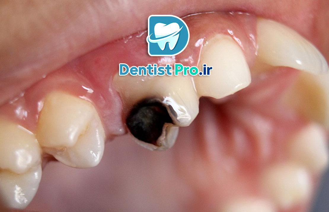 علت سیاه شدن دندان از داخل