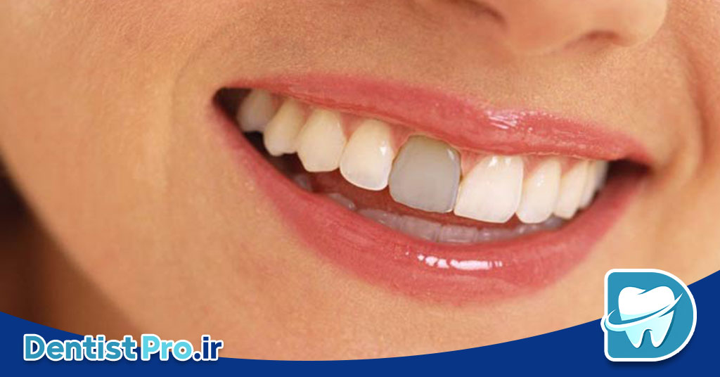 علت سیاه شدن دندان از داخل