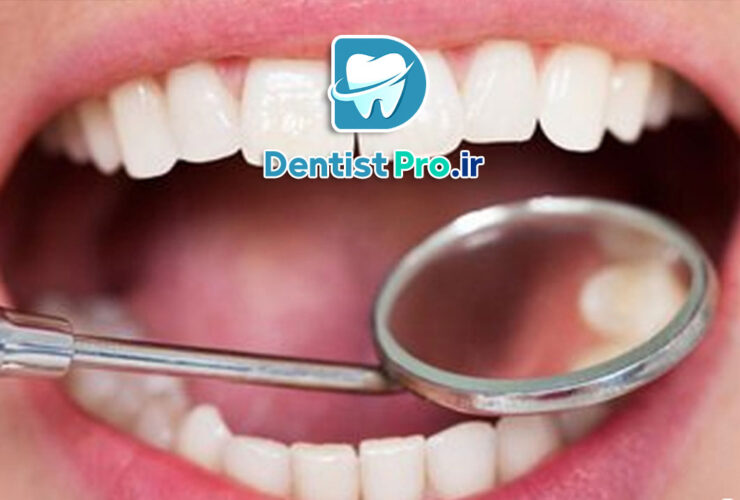 علت سوراخ شدن دندان بدون کرم خوردگی+موارد 100% علمی
