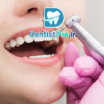 جرم گیری عمیق دندان با دستگاه اولتراسونیک: راهنمای جامع