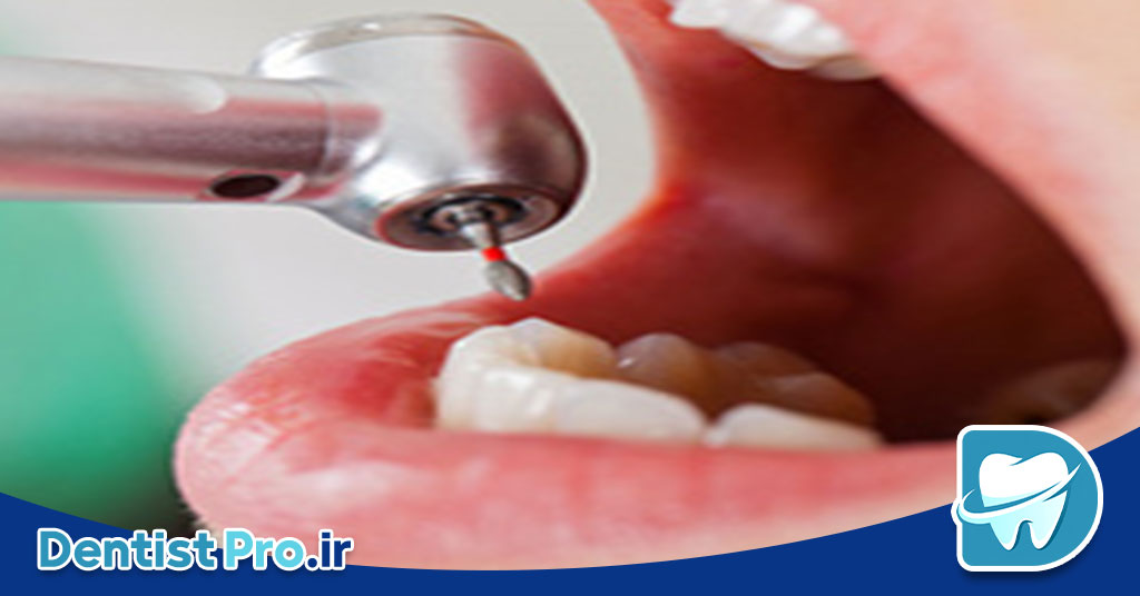 پر کردن دندان بدون صدای دریل: انقلابی در دندانپزشکی مدرن 27 پر کردن دندان بدون صدای دریل: انقلابی در دندانپزشکی مدرن