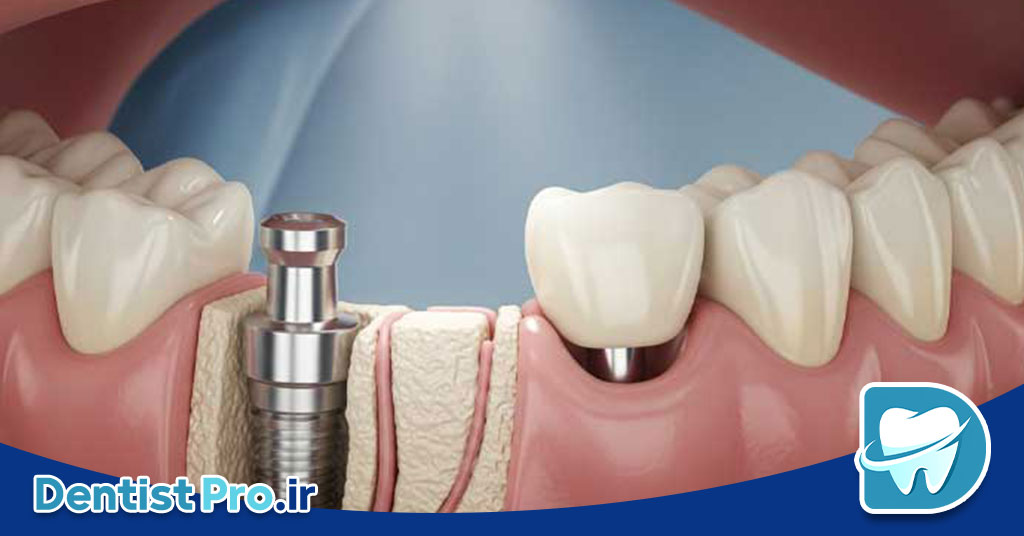 تعویض ایمپلنت دندان؛ دلایل، مراحل و نکات مهم 28 تعویض ایمپلنت دندان؛ دلایل، مراحل و نکات مهم