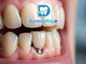 تعویض ایمپلنت دندان؛ دلایل، مراحل و نکات مهم