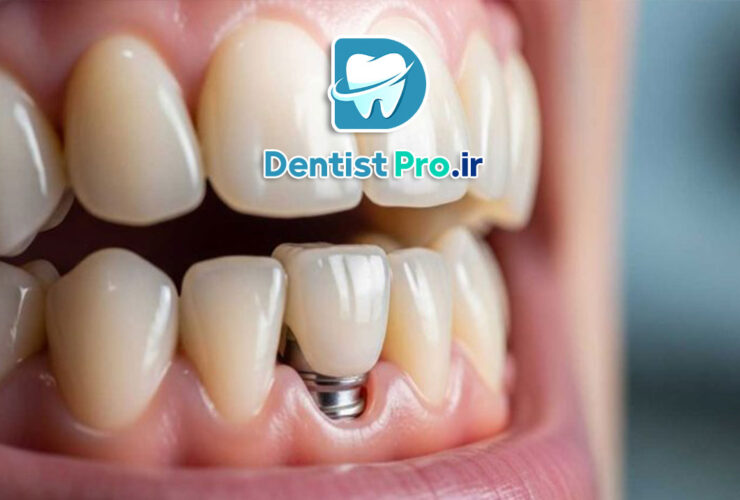 تعویض ایمپلنت دندان؛ دلایل، مراحل و نکات مهم 40 تعویض ایمپلنت دندان؛ دلایل، مراحل و نکات مهم