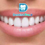 لمینت دندان برای بازیگران: راز لبخندهای درخشان در سینما و تلویزیون