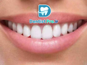 لمینت دندان برای بازیگران: راز لبخندهای درخشان در سینما و تلویزیون