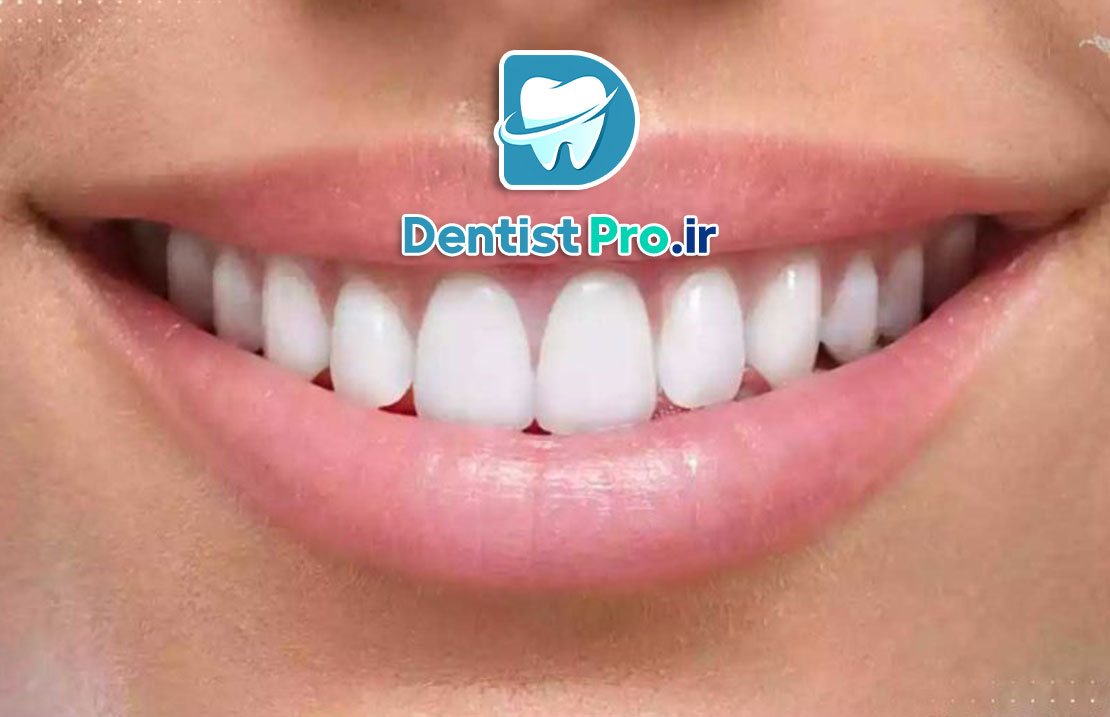 لمینت دندان برای بازیگران: راز لبخندهای درخشان در سینما و تلویزیون