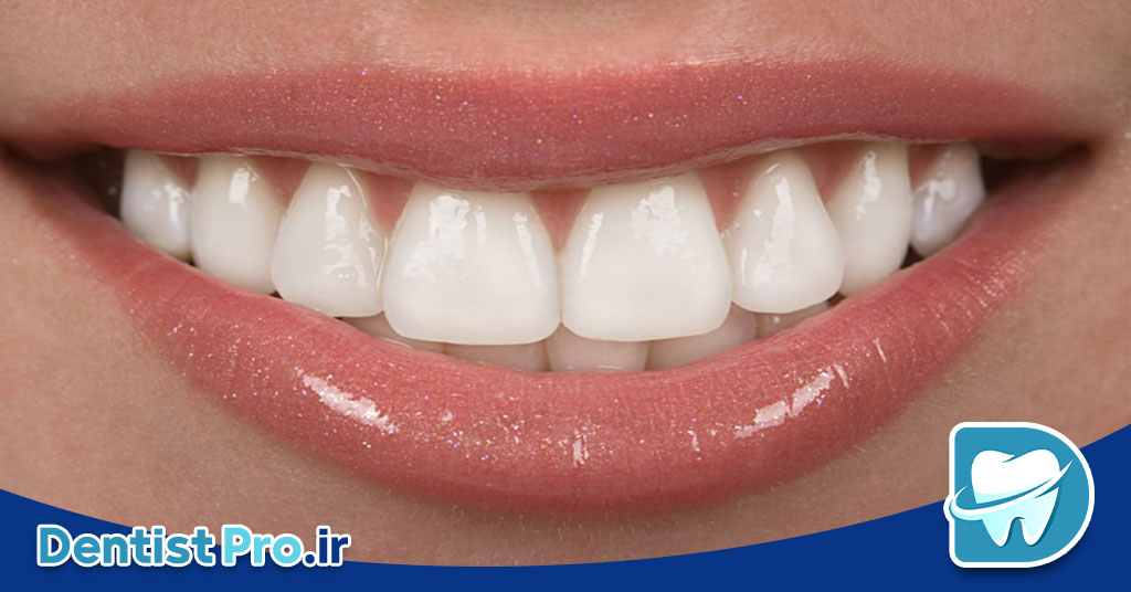 لمینت دندان برای بازیگران: راز لبخندهای درخشان در سینما و تلویزیون