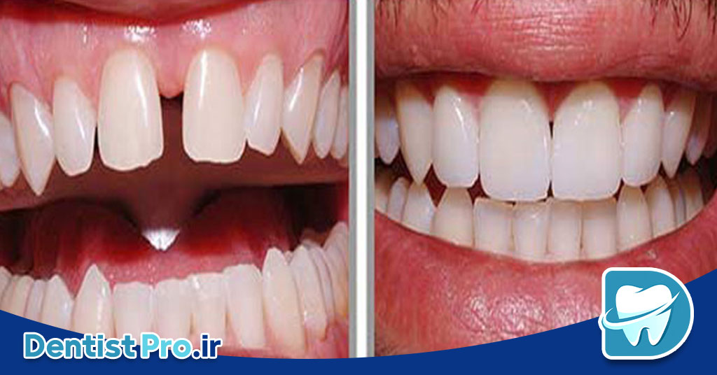 لمینت دندان برای دندان‌های فاصله‌دار: راهنمای جامع و کامل