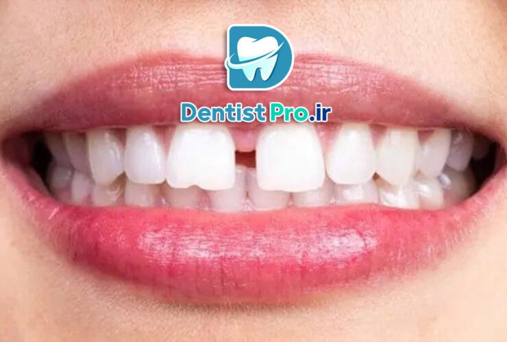 لمینت دندان برای دندان‌های فاصله‌دار: راهنمای جامع و کامل