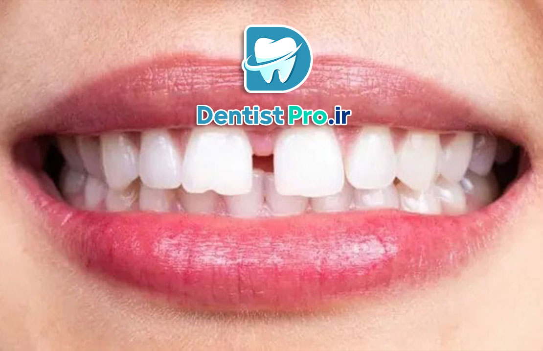 لمینت دندان برای دندان‌های فاصله‌دار: راهنمای جامع و کامل