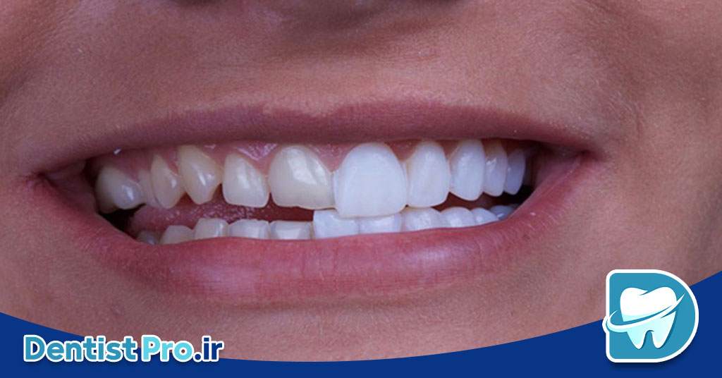 لمینت دندان بدون تراش مینای دندان: راهکاری نوین برای زیبایی لبخند