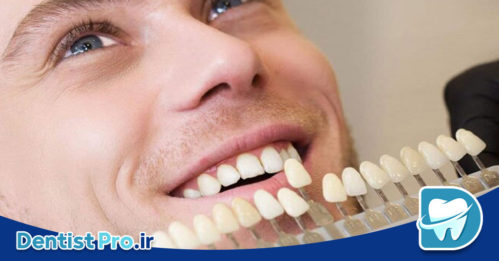 تفاوت کامپوزیت دندان ایرانی و خارجی: بررسی تخصصی کیفیت، قیمت و ماندگاری