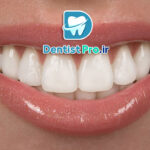 تفاوت کامپوزیت دندان ایرانی و خارجی: بررسی تخصصی کیفیت، قیمت و ماندگاری