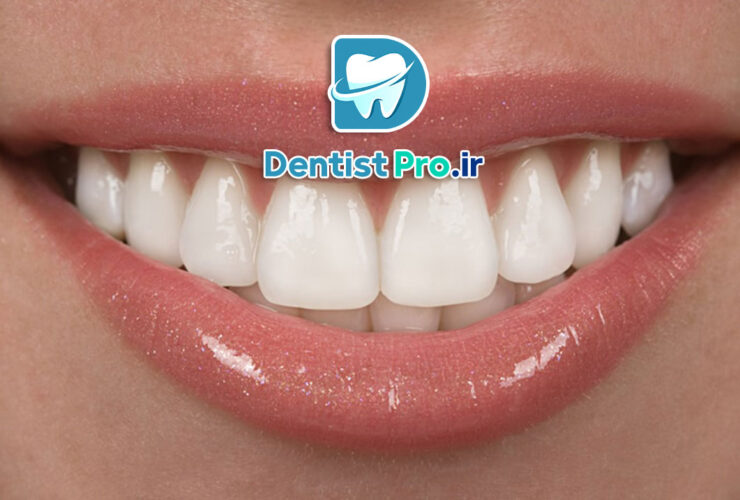 تفاوت کامپوزیت دندان ایرانی و خارجی: بررسی تخصصی کیفیت، قیمت و ماندگاری