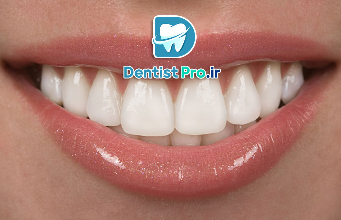 تفاوت کامپوزیت دندان ایرانی و خارجی: بررسی تخصصی کیفیت، قیمت و ماندگاری
