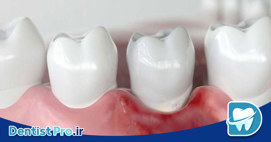 تفاوت بین ژنژیویت و پریودنتیت؛ شناخت دقیق بیماری‌های لثه و راهکارهای درمانی