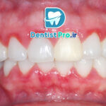 تفاوت بین ژنژیویت و پریودنتیت؛ شناخت دقیق بیماری‌های لثه و راهکارهای درمانی