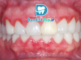 تفاوت بین ژنژیویت و پریودنتیت؛ شناخت دقیق بیماری‌های لثه و راهکارهای درمانی