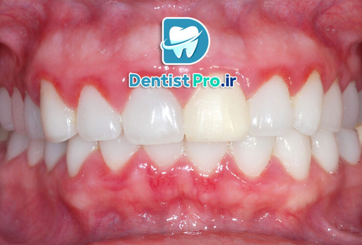 تفاوت بین ژنژیویت و پریودنتیت؛ شناخت دقیق بیماری‌های لثه و راهکارهای درمانی