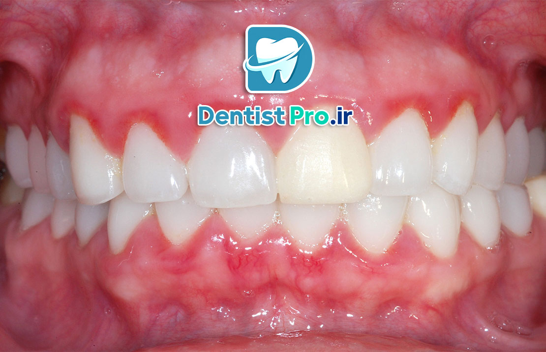 تفاوت بین ژنژیویت و پریودنتیت؛ شناخت دقیق بیماری‌های لثه و راهکارهای درمانی