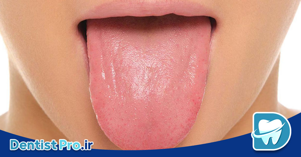 صفر تا صد بیماری های زبان+ موارد بسیار مهم در مورد زبان 28 بیماری های زبان: شناخت، علل، علائم و روشهای درمان