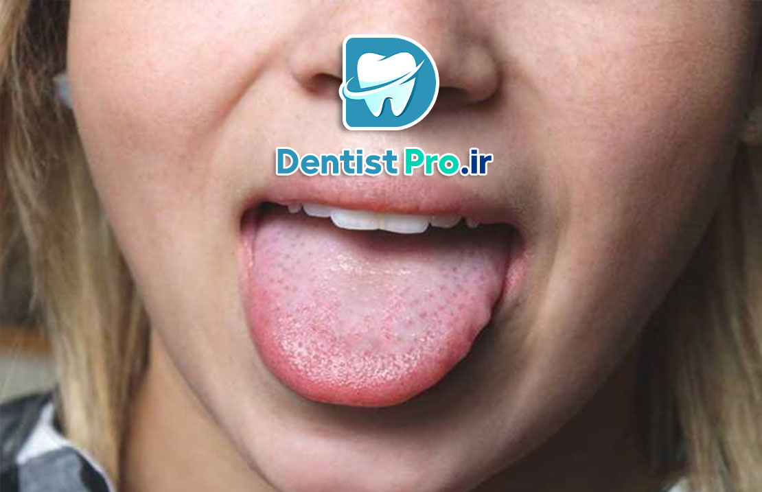 صفر تا صد بیماری های زبان+ موارد بسیار مهم در مورد زبان 25 بیماری های زبان: شناخت، علل، علائم و روشهای درمان