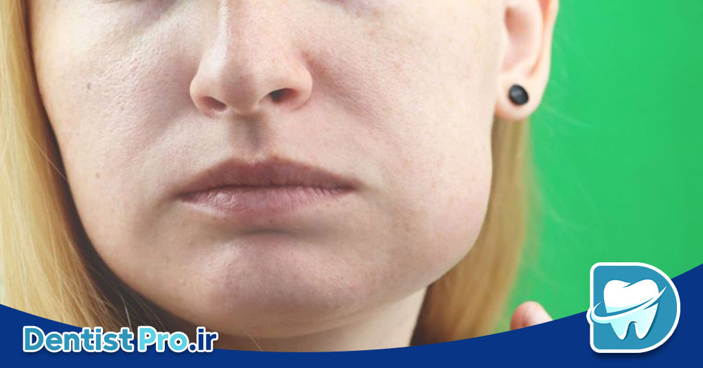 ورم صورت بعد از ایمپلنت دندان؛ علل، روش‌های کنترل و مراقبت‌های لازم